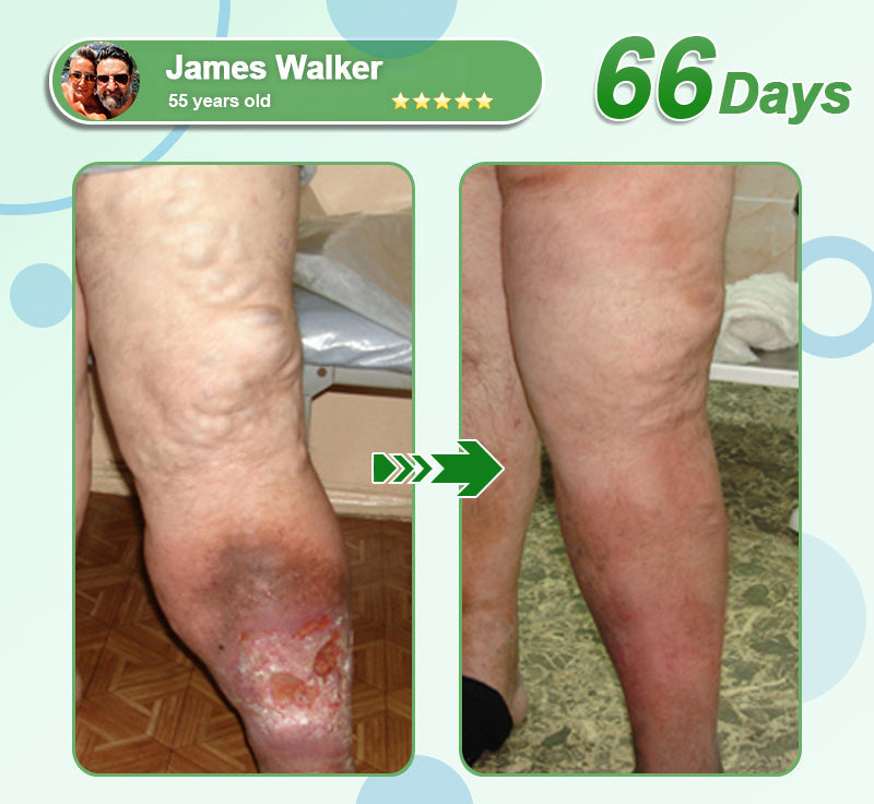 [See results in 7 days]🔔Croaie® SMGT-GLP-1 Nano Microneedle Patch & Matrixyl™  3000（Painless, long-lasting, addressing diabetes, obesity, and cardiovascular diseases）💚