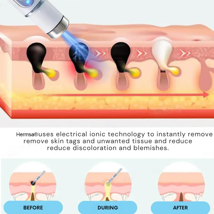 ✨Hermsa® Removal Laser Pen