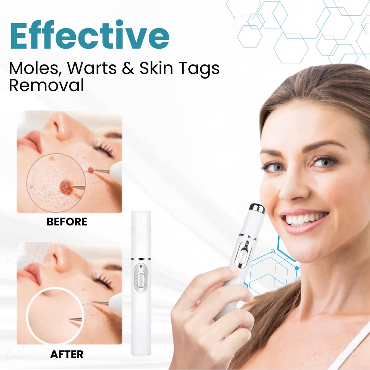 ✨Hermsa® Removal Laser Pen